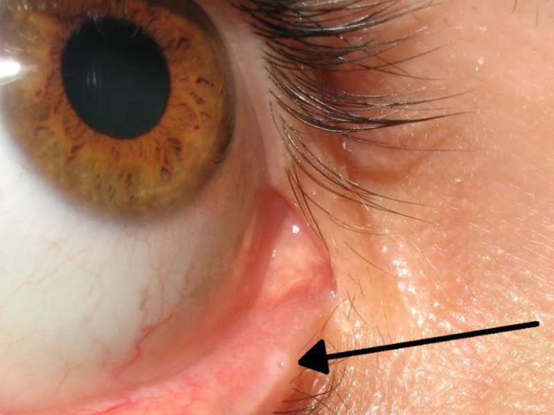 Did You Know? There’s a hole in your eyelids